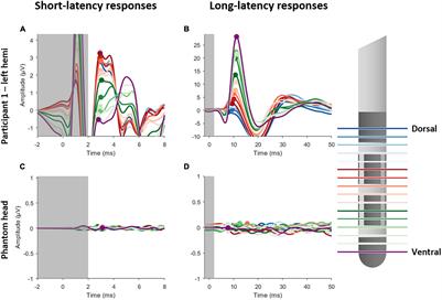 Current Steering Using Multiple Independent Current Control Deep Brain Stimulation Technology Results in Distinct Neurophysiological Responses in Parkinson’s Disease Patients